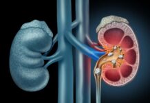 Магнитный гель может более эффективно удалять камни в почках